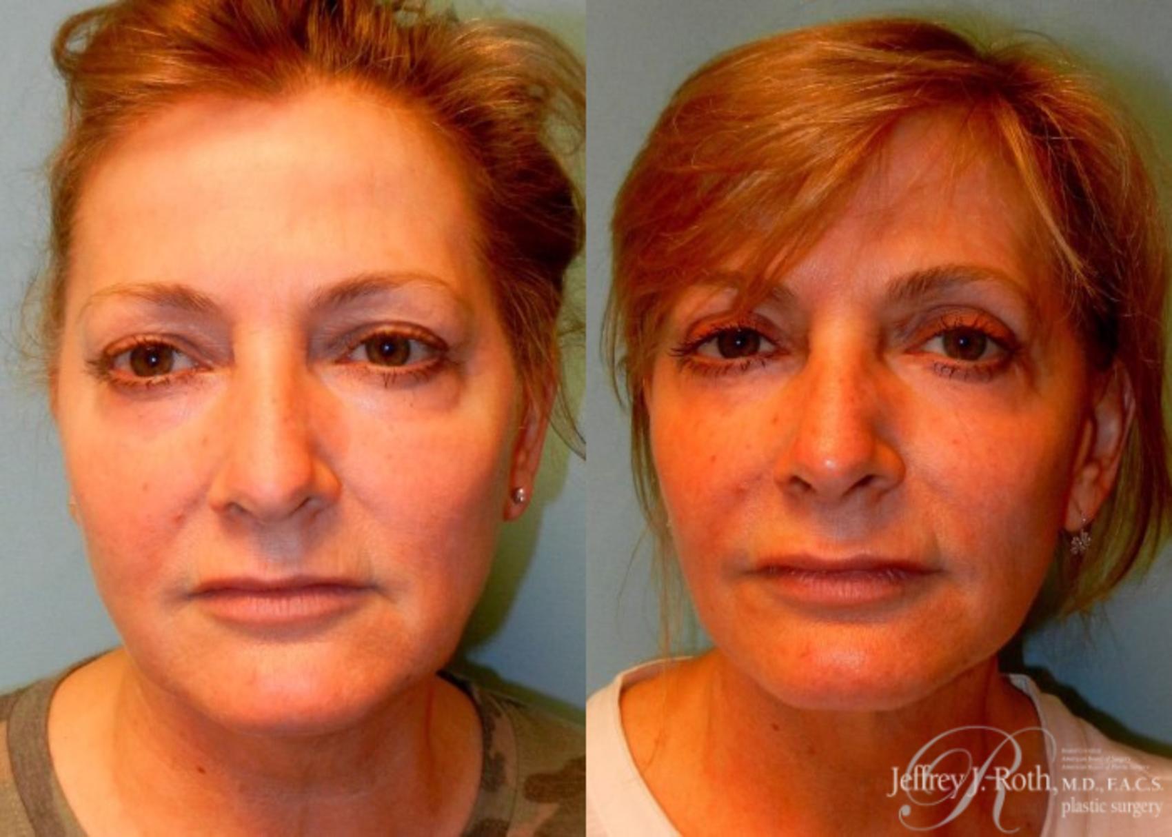 Before & After Facelift & Neck Lift Case 145 View #1 View in Las Vegas, NV