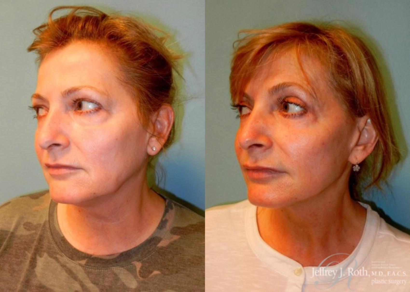 Before & After Eyelid Surgery Case 145 View #2 View in Las Vegas, NV