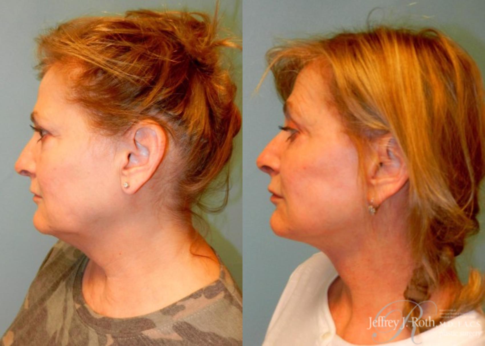 Before & After Facelift & Neck Lift Case 145 View #3 View in Las Vegas, NV