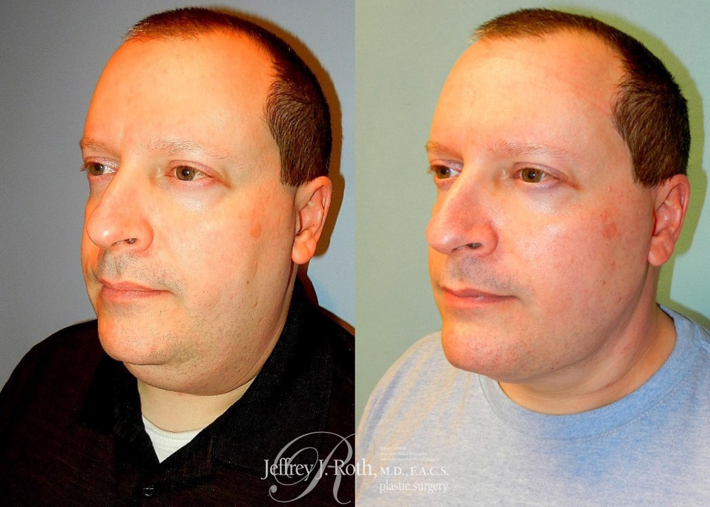 Before & After Facelift & Neck Lift for Men Case 171 View #2 View in Las Vegas, NV