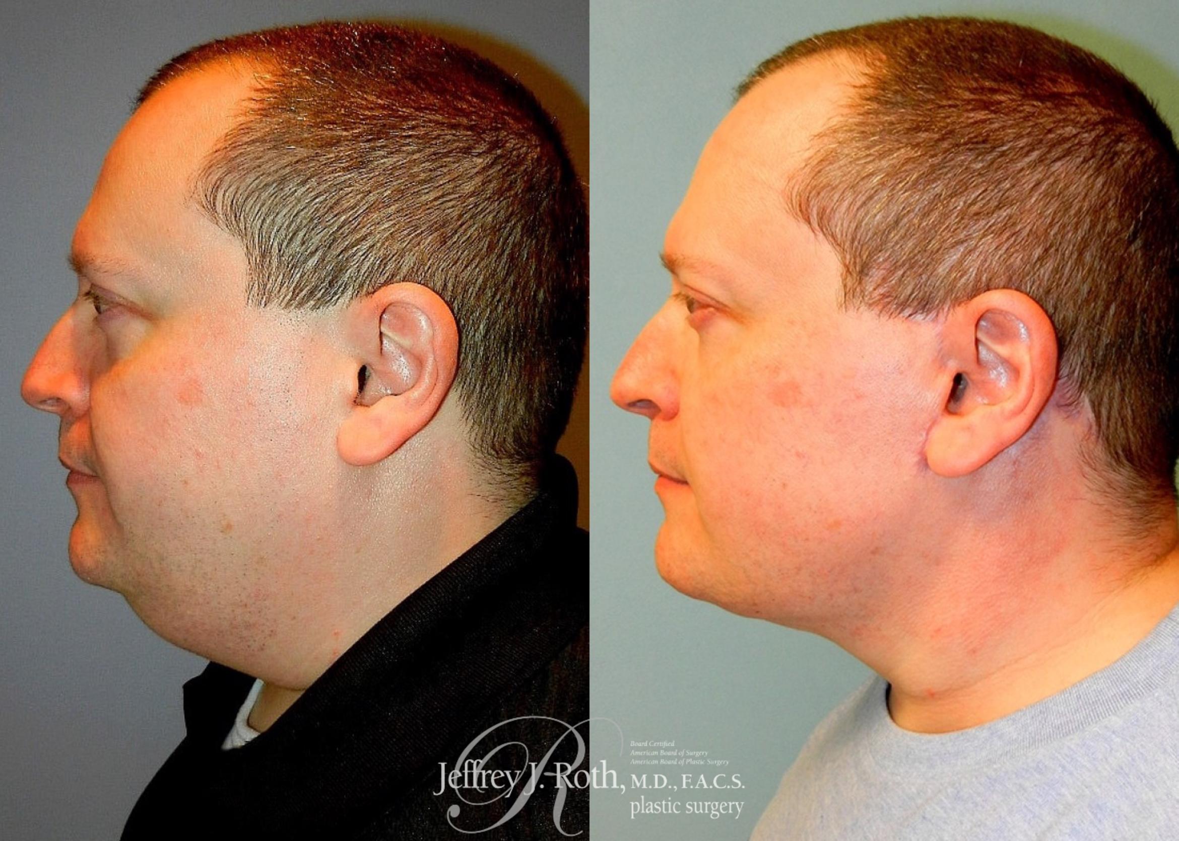 Before & After Facelift & Neck Lift for Men Case 171 View #3 View in Las Vegas, NV