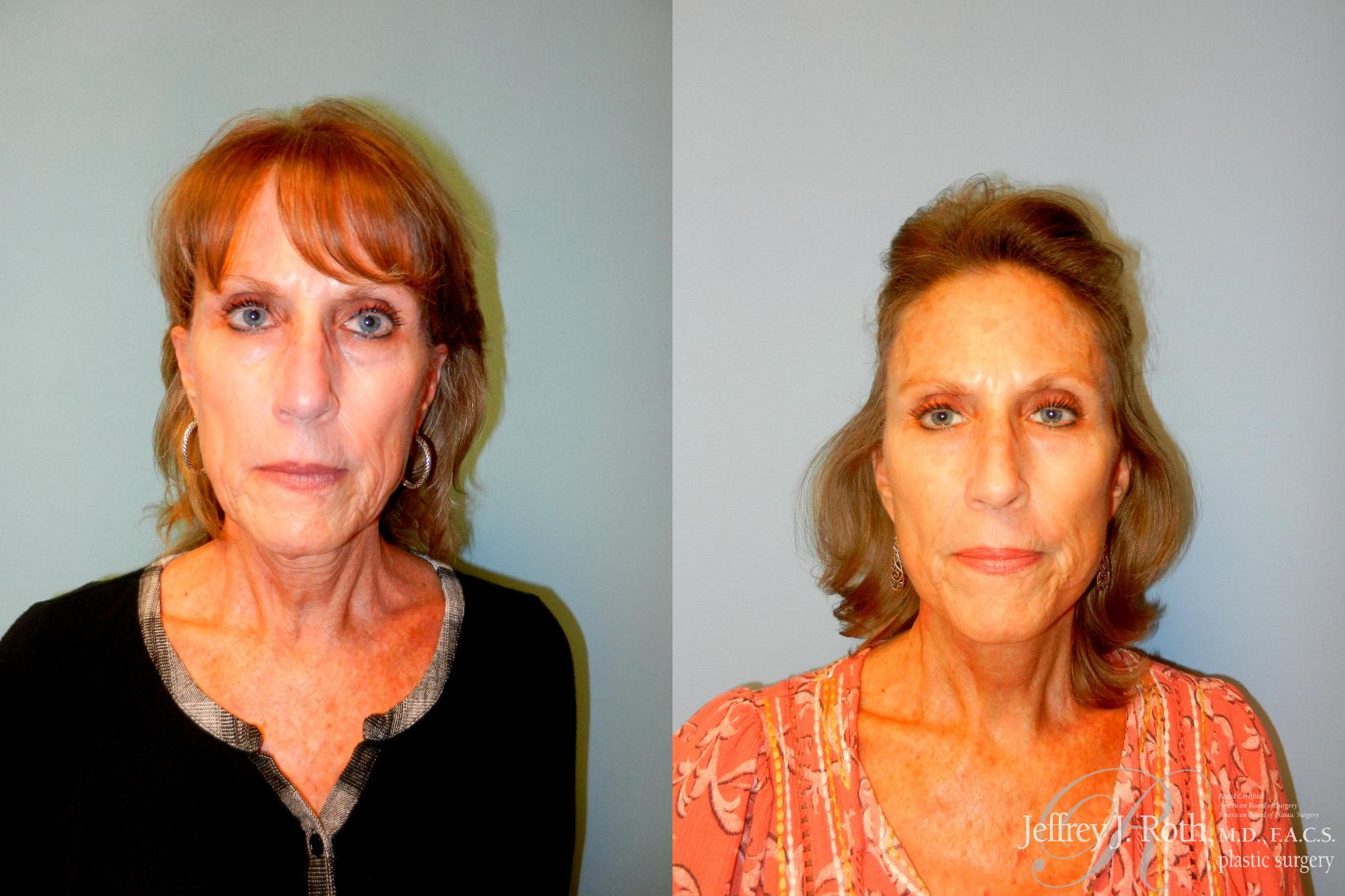 Before & After Facelift & Neck Lift Case 227 Front View in Las Vegas, NV