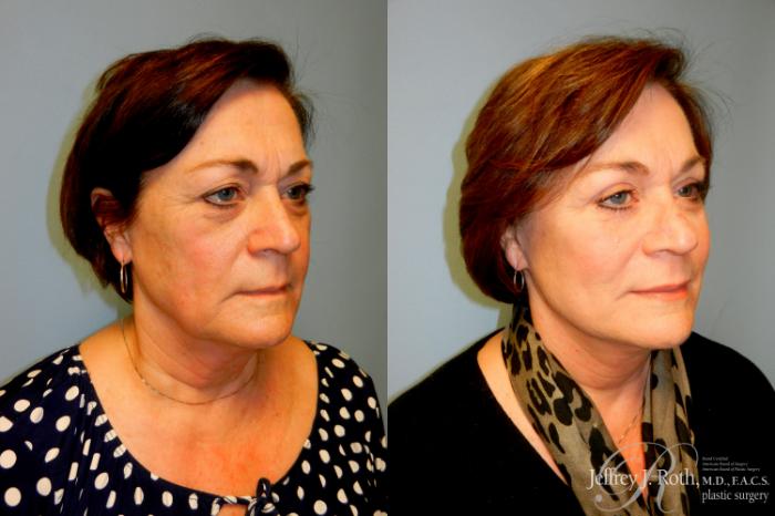 Before & After Facelift & Neck Lift Case 238 Right Oblique View in Las Vegas and Henderson, NV
