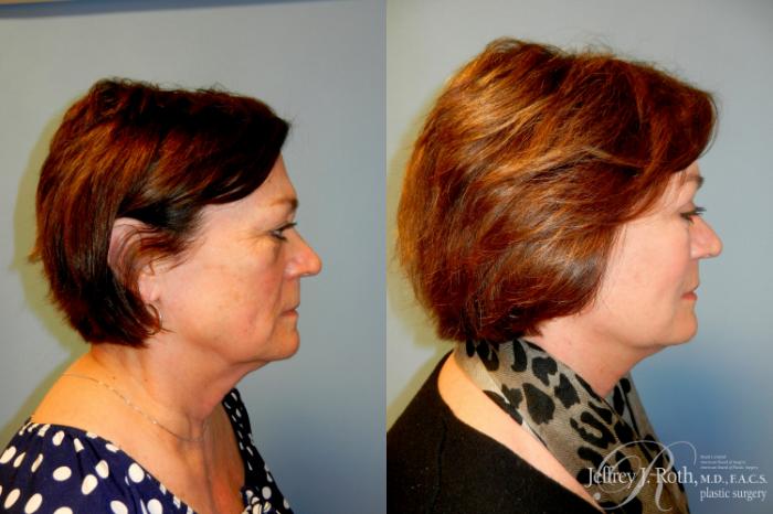 Before & After Facelift & Neck Lift Case 238 Right Side View in Las Vegas and Henderson, NV