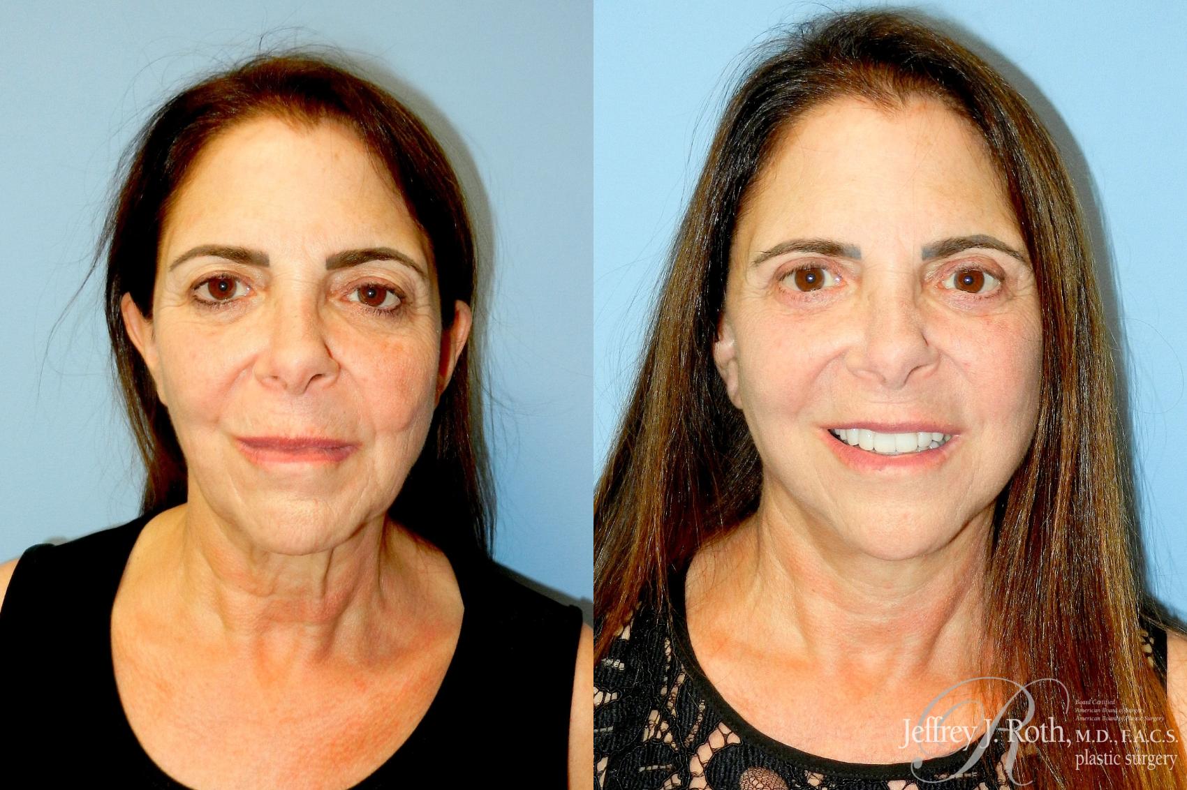 Before & After Facelift & Neck Lift Case 335 Front View in Las Vegas and Henderson, NV