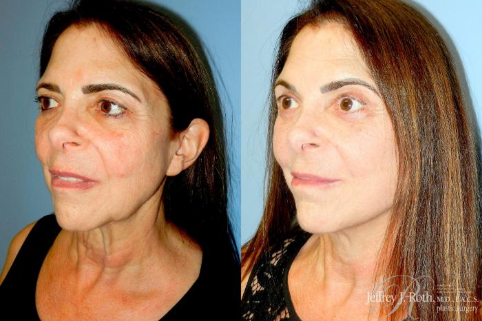 Before & After Facelift & Neck Lift Case 335 Left Oblique View in Las Vegas and Henderson, NV