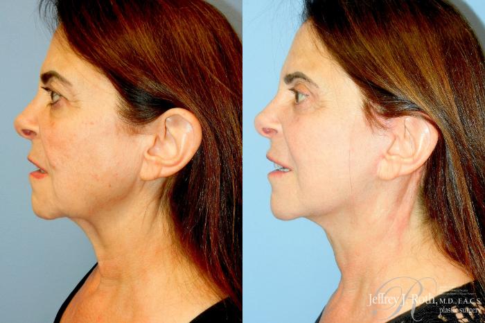 Before & After Facelift & Neck Lift Case 335 Left Side View in Las Vegas and Henderson, NV