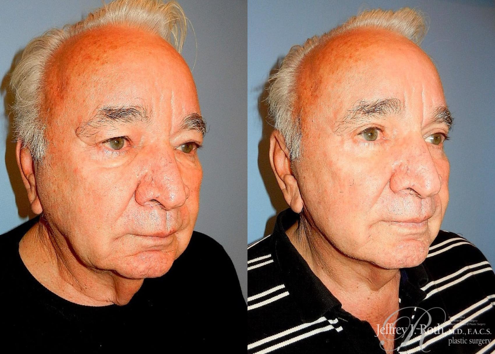 Before & After Facelift & Neck Lift for Men Case 170 View #2 View in Las Vegas, NV