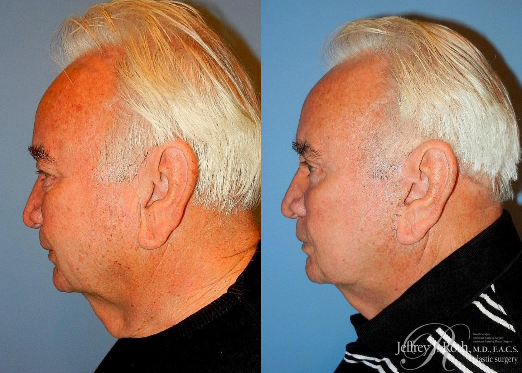 Before & After Facelift & Neck Lift for Men Case 170 View #3 View in Las Vegas, NV