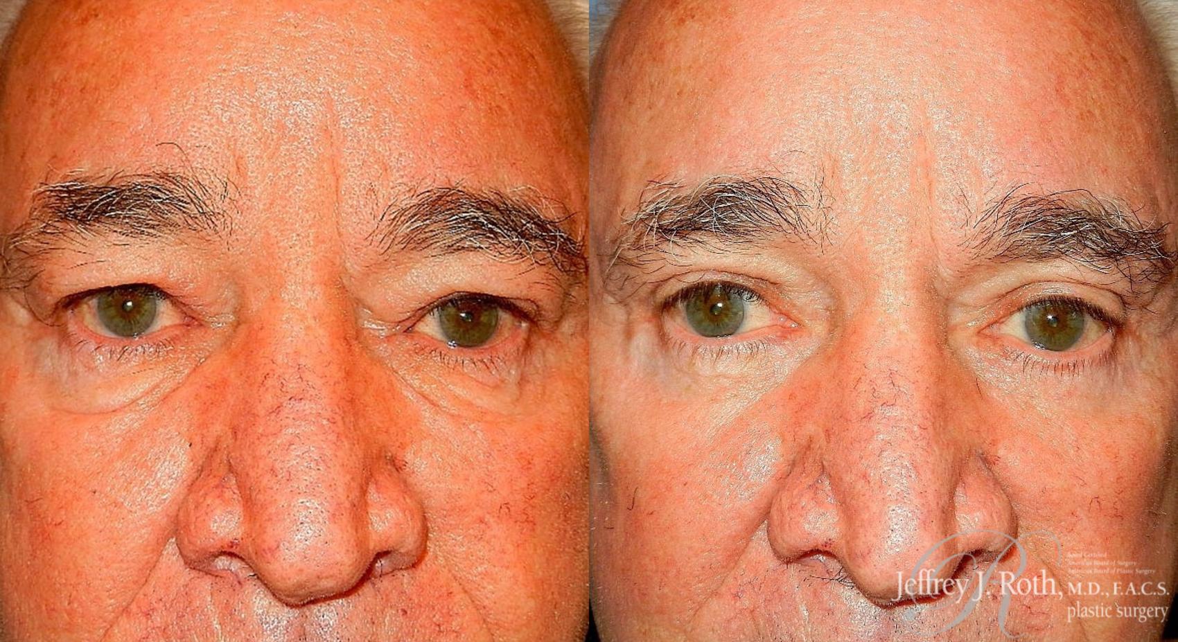 Before & After Facelift & Neck Lift for Men Case 170 View #4 View in Las Vegas, NV