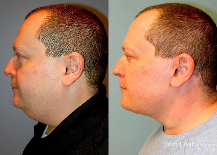Before & After Facelift & Neck Lift for Men Case 171 View #3 View in Las Vegas, NV