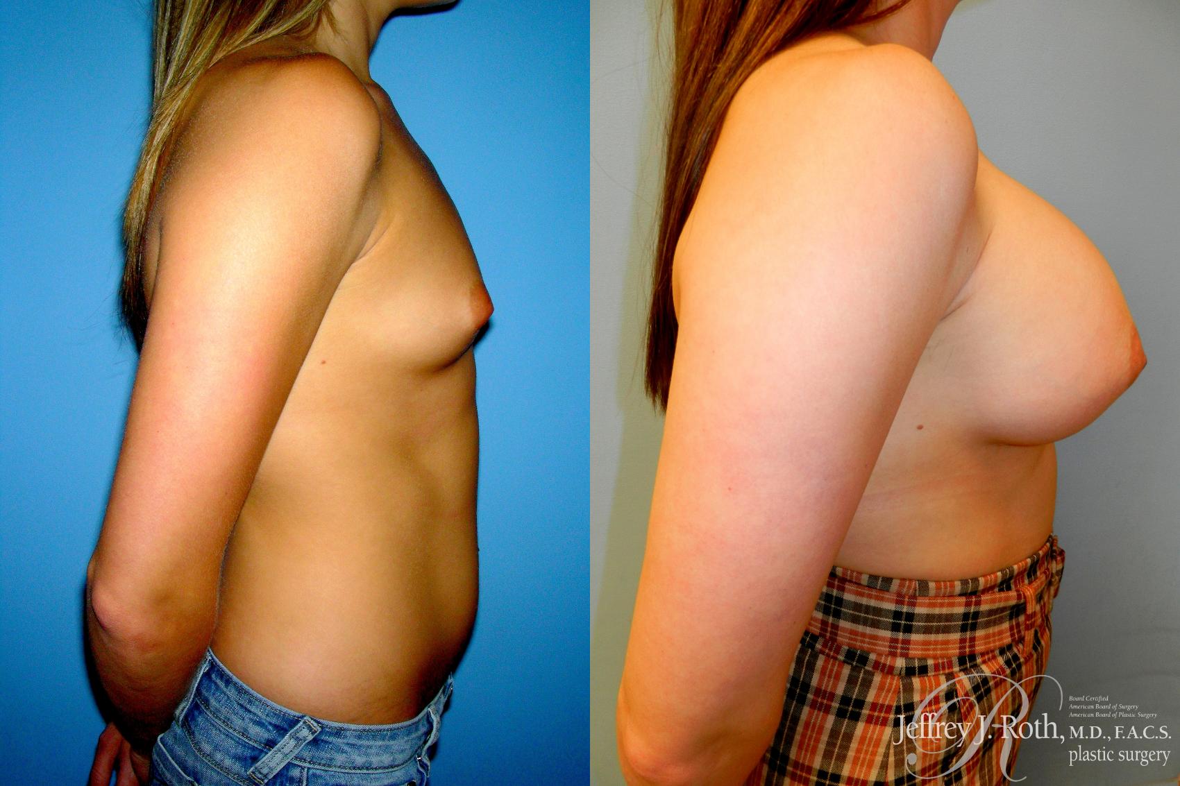 Before & After Large Breast Augmentation Case 181 Right Side View in Las Vegas, NV