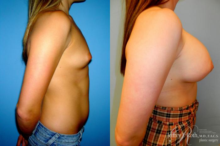 Before & After Large Breast Augmentation Case 181 Right Side View in Las Vegas and Henderson, NV