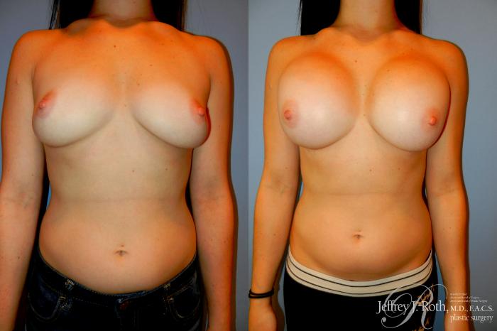 Before & After Large Breast Augmentation Case 200 Front View in Las Vegas, NV