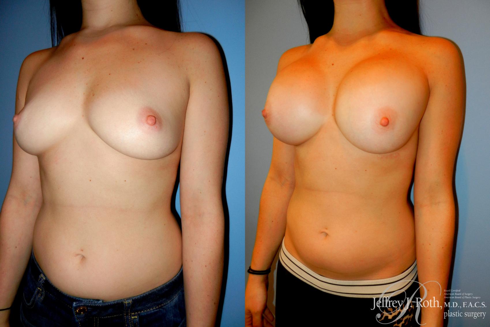 Before & After Large Breast Augmentation Case 200 Left Oblique View in Las Vegas, NV