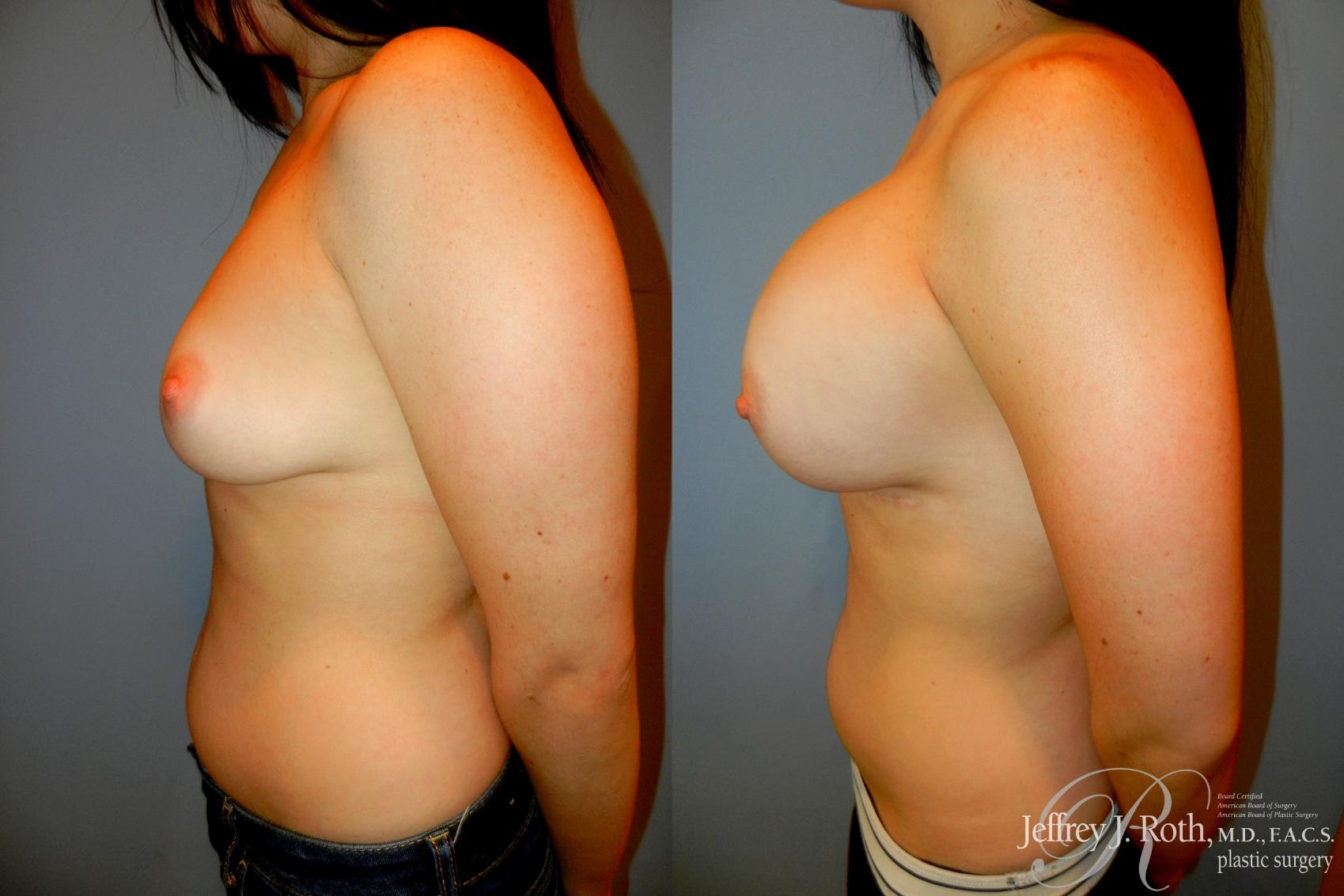 Before & After Large Breast Augmentation Case 200 Left Side View in Las Vegas, NV