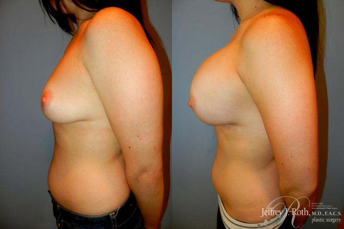 Before & After Large Breast Augmentation Case 200 Left Side View in Las Vegas and Henderson, NV