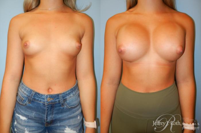 Before & After Large Breast Augmentation Case 207 Front View in Las Vegas, NV