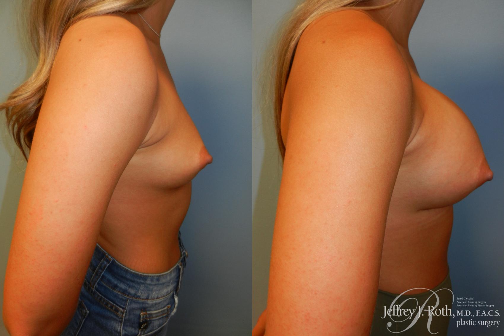Before & After Large Breast Augmentation Case 207 Right Side View in Las Vegas, NV
