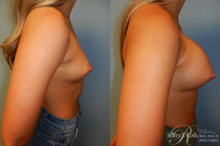 Before & After Large Breast Augmentation Case 207 Right Side View in Las Vegas and Henderson, NV
