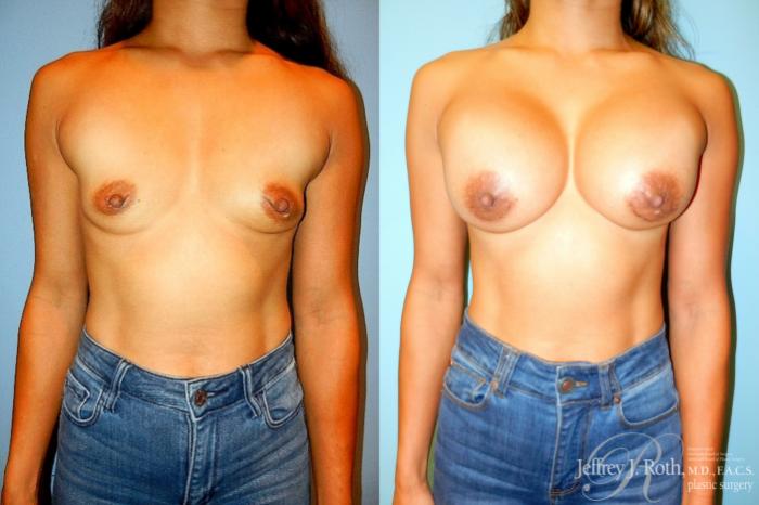 Before & After Large Breast Augmentation Case 320 Front View in Las Vegas and Henderson, NV