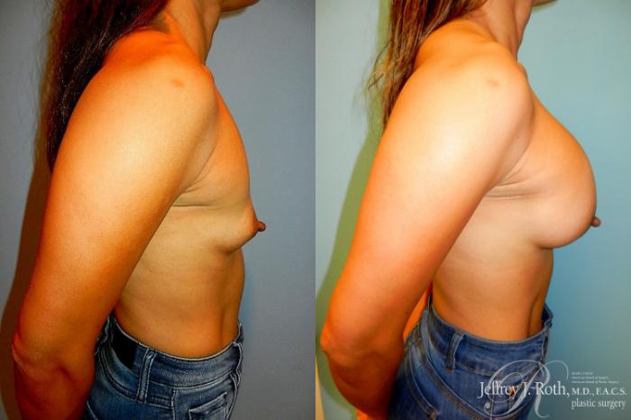 Before & After Large Breast Augmentation Case 320 Right Side View in Las Vegas and Henderson, NV