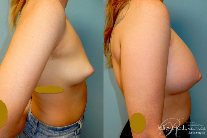 Before & After Large Breast Augmentation Case 327 Right Side View in Las Vegas and Henderson, NV