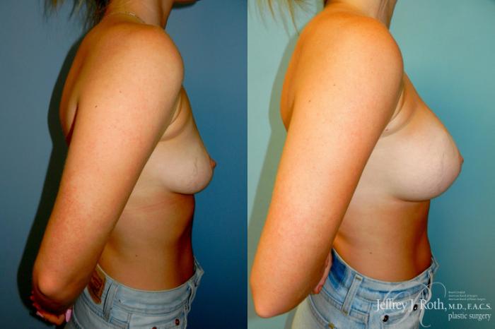 Before & After Large Breast Augmentation Case 337 Right Side View in Las Vegas and Henderson, NV