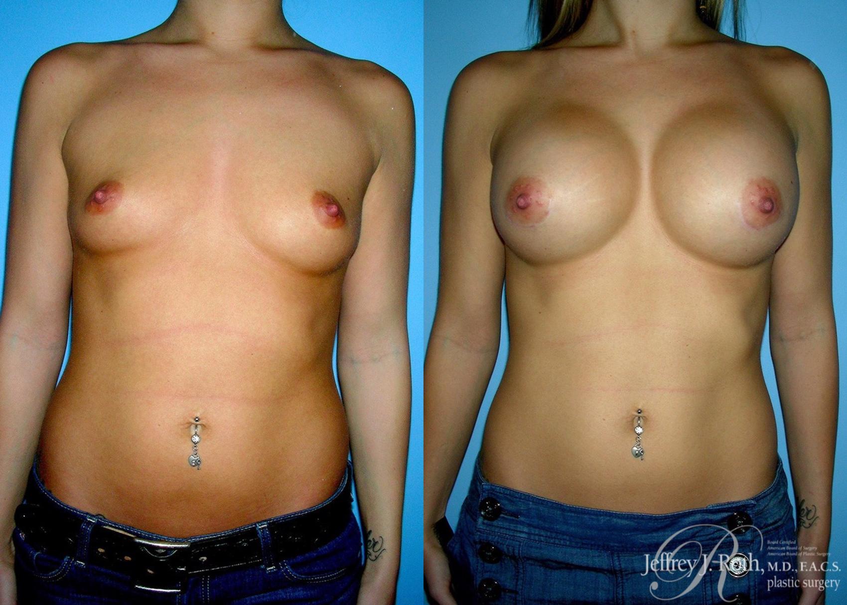Before & After Large Breast Augmentation Case 38 View #1 View in Las Vegas, NV