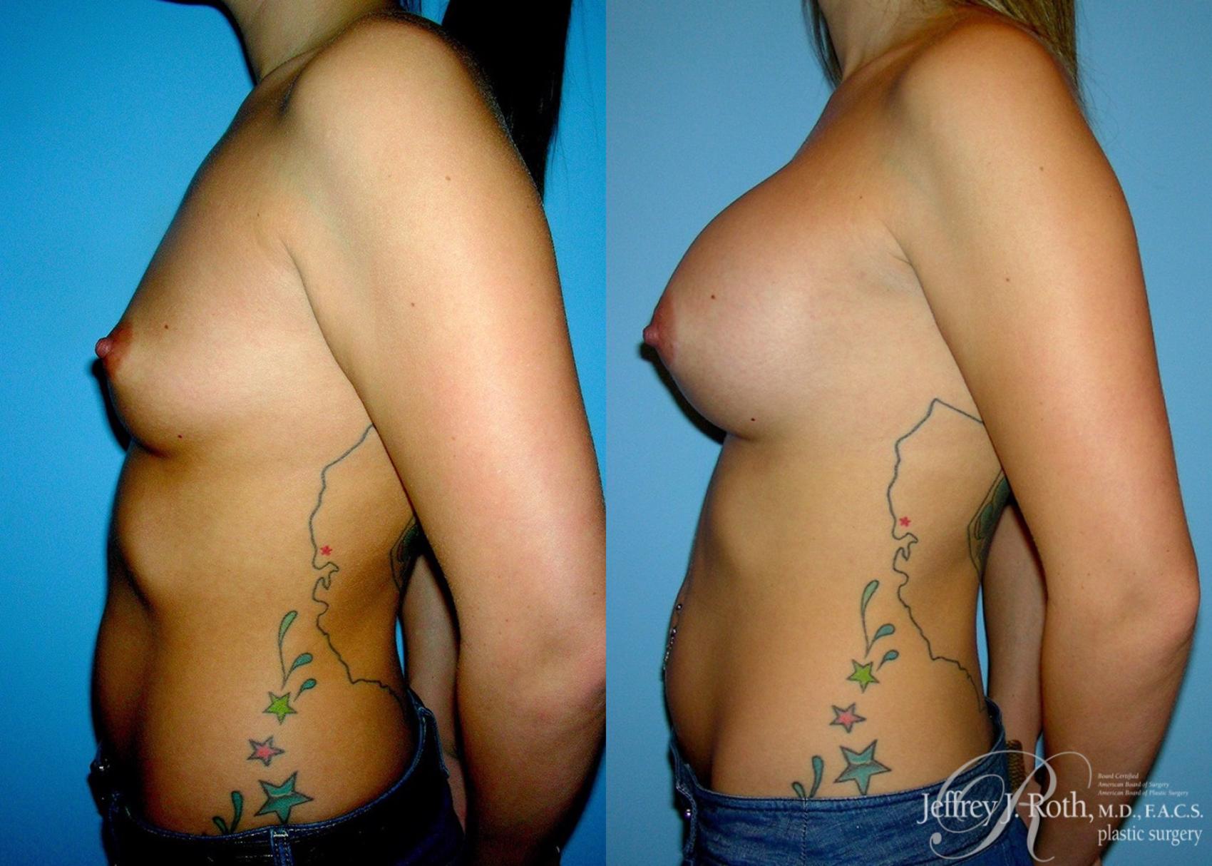 Before & After Large Breast Augmentation Case 38 View #3 View in Las Vegas, NV