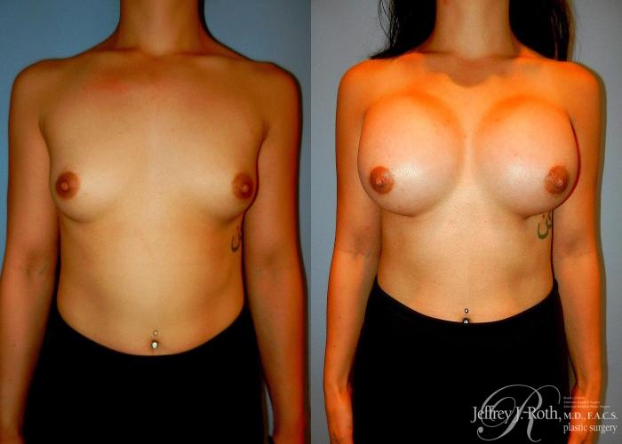 Before & After Large Breast Augmentation Case 41 View #1 View in Las Vegas, NV