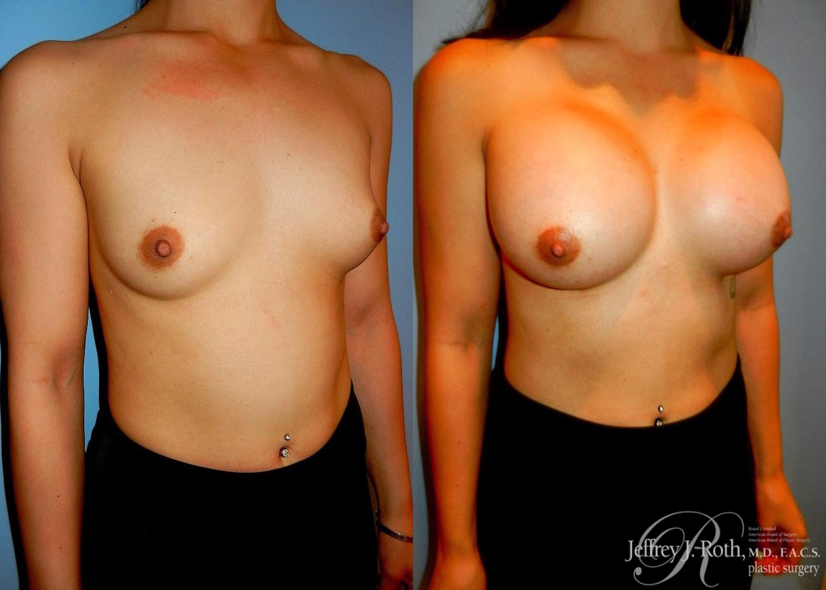 Before & After Large Breast Augmentation Case 41 View #2 View in Las Vegas, NV