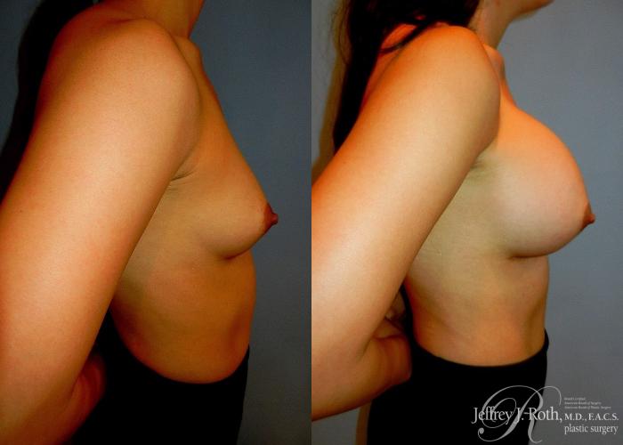 Before & After Large Breast Augmentation Case 41 View #3 View in Las Vegas and Henderson, NV