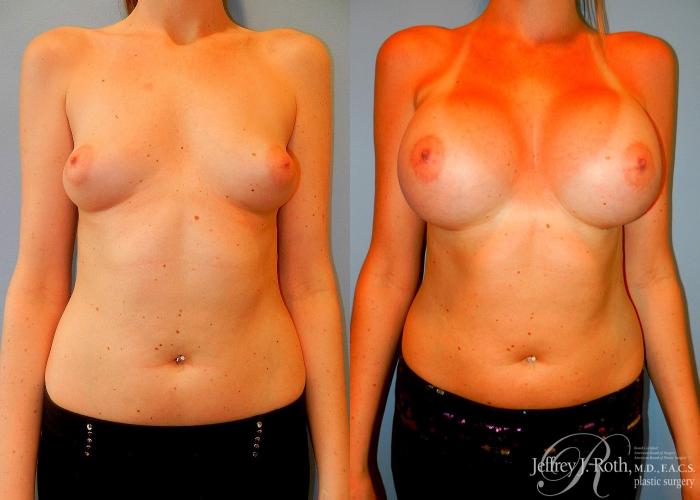 Before & After Large Breast Augmentation Case 90 View #1 View in Las Vegas, NV