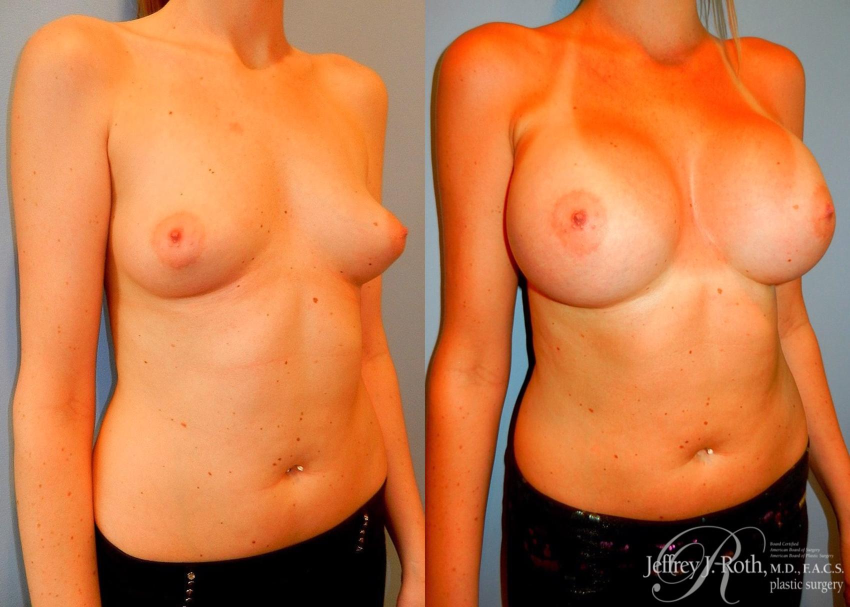 Before & After Large Breast Augmentation Case 90 View #2 View in Las Vegas, NV