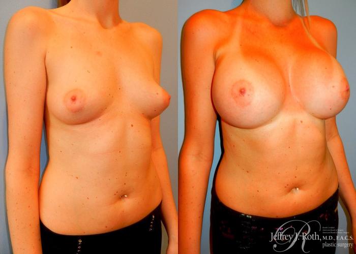 Before & After Large Breast Augmentation Case 90 View #2 View in Las Vegas and Henderson, NV