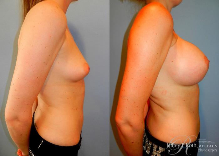 Before & After Large Breast Augmentation Case 90 View #3 View in Las Vegas and Henderson, NV