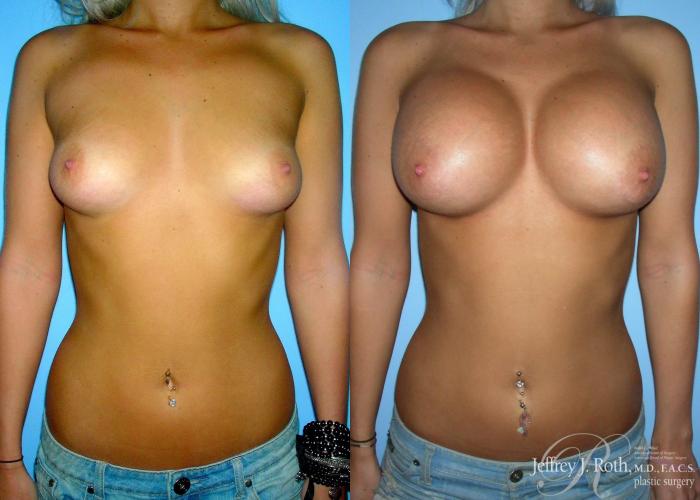 Before & After Large Breast Augmentation Case 91 View #1 View in Las Vegas, NV