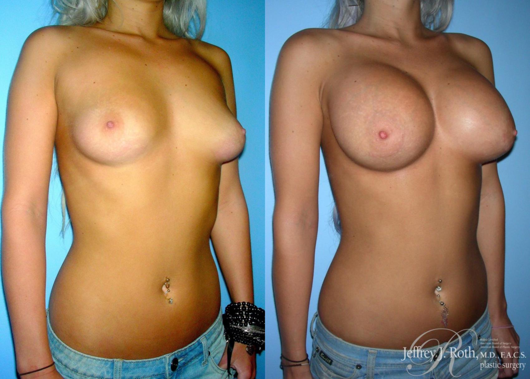 Before & After Large Breast Augmentation Case 91 View #2 View in Las Vegas, NV