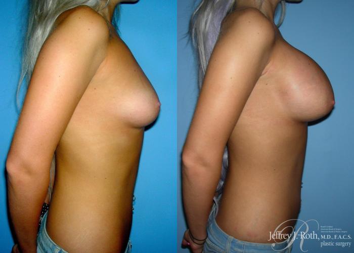 Before & After Large Breast Augmentation Case 91 View #3 View in Las Vegas and Henderson, NV
