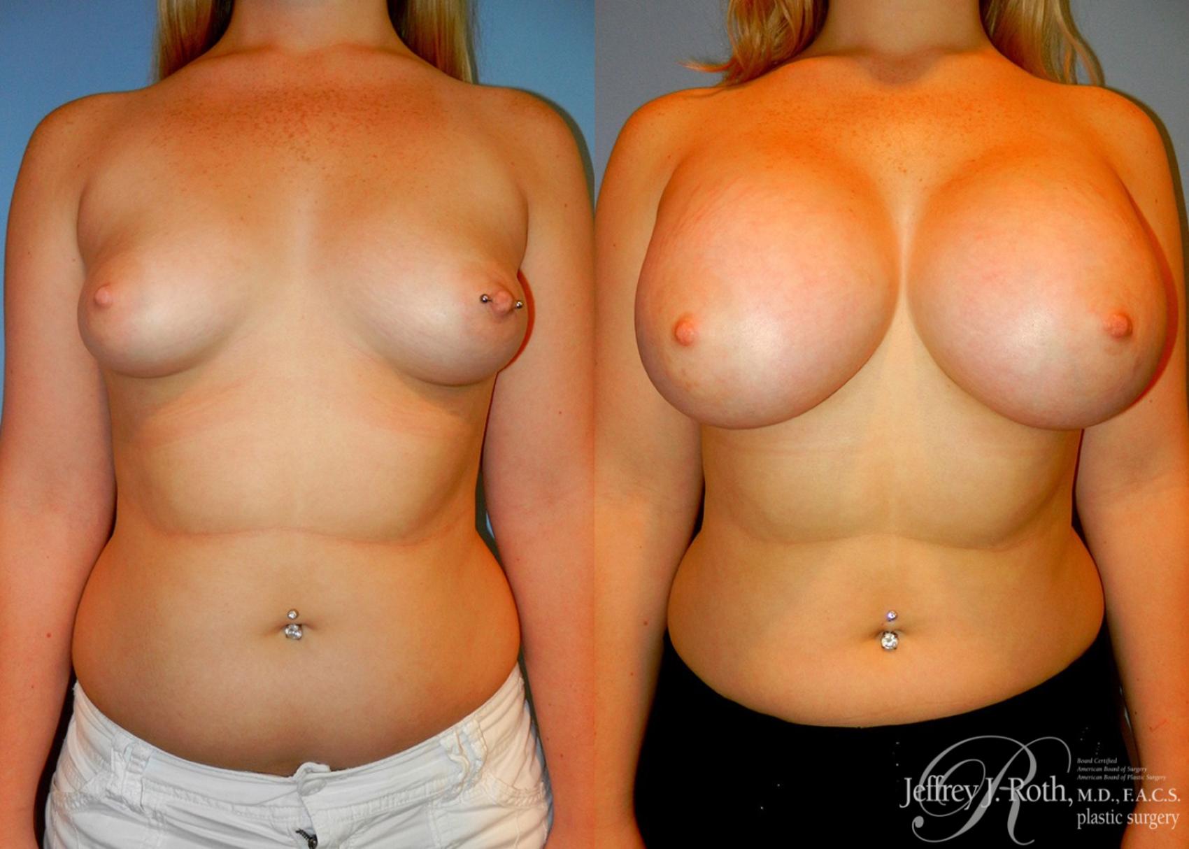 Before & After Large Breast Augmentation Case 92 View #1 View in Las Vegas, NV
