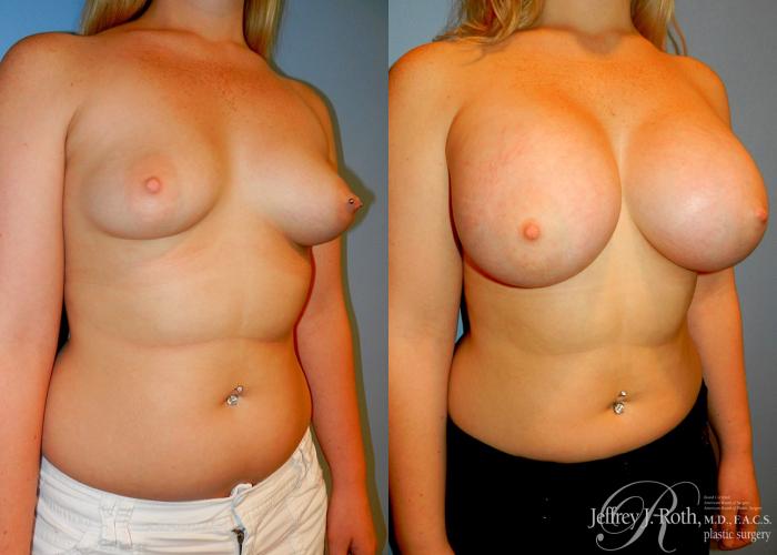 Before & After Large Breast Augmentation Case 92 View #2 View in Las Vegas and Henderson, NV