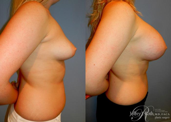 Before & After Large Breast Augmentation Case 92 View #3 View in Las Vegas and Henderson, NV