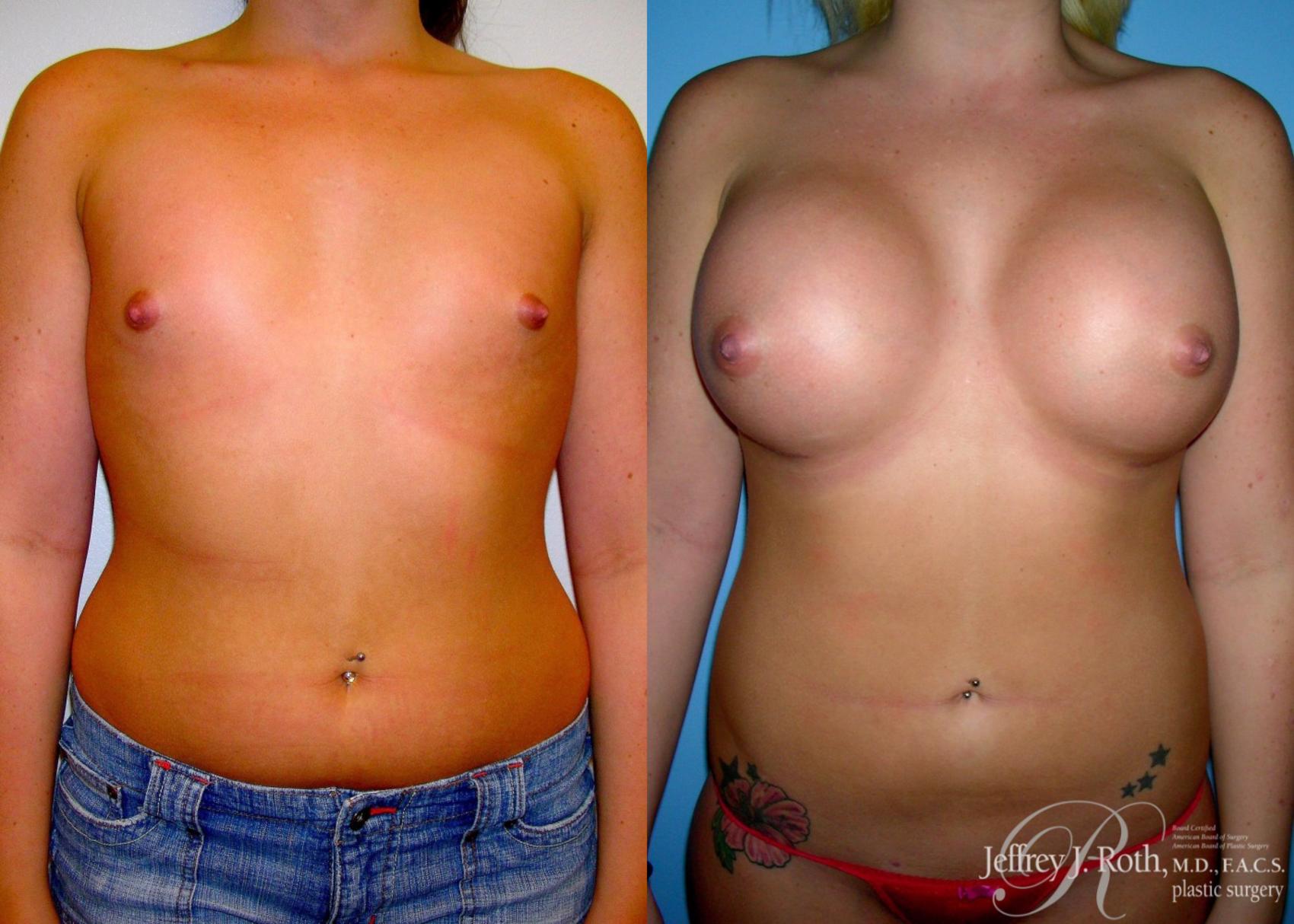 Before & After Large Breast Augmentation Case 93 View #1 View in Las Vegas, NV