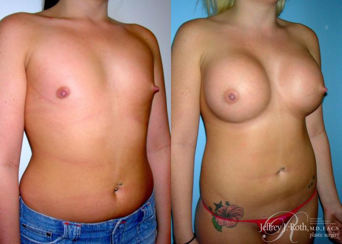 Before & After Large Breast Augmentation Case 93 View #2 View in Las Vegas and Henderson, NV