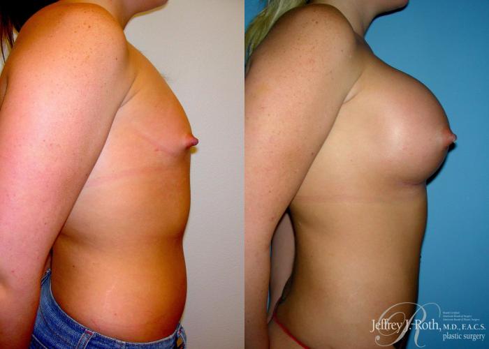 Before & After Large Breast Augmentation Case 93 View #3 View in Las Vegas and Henderson, NV