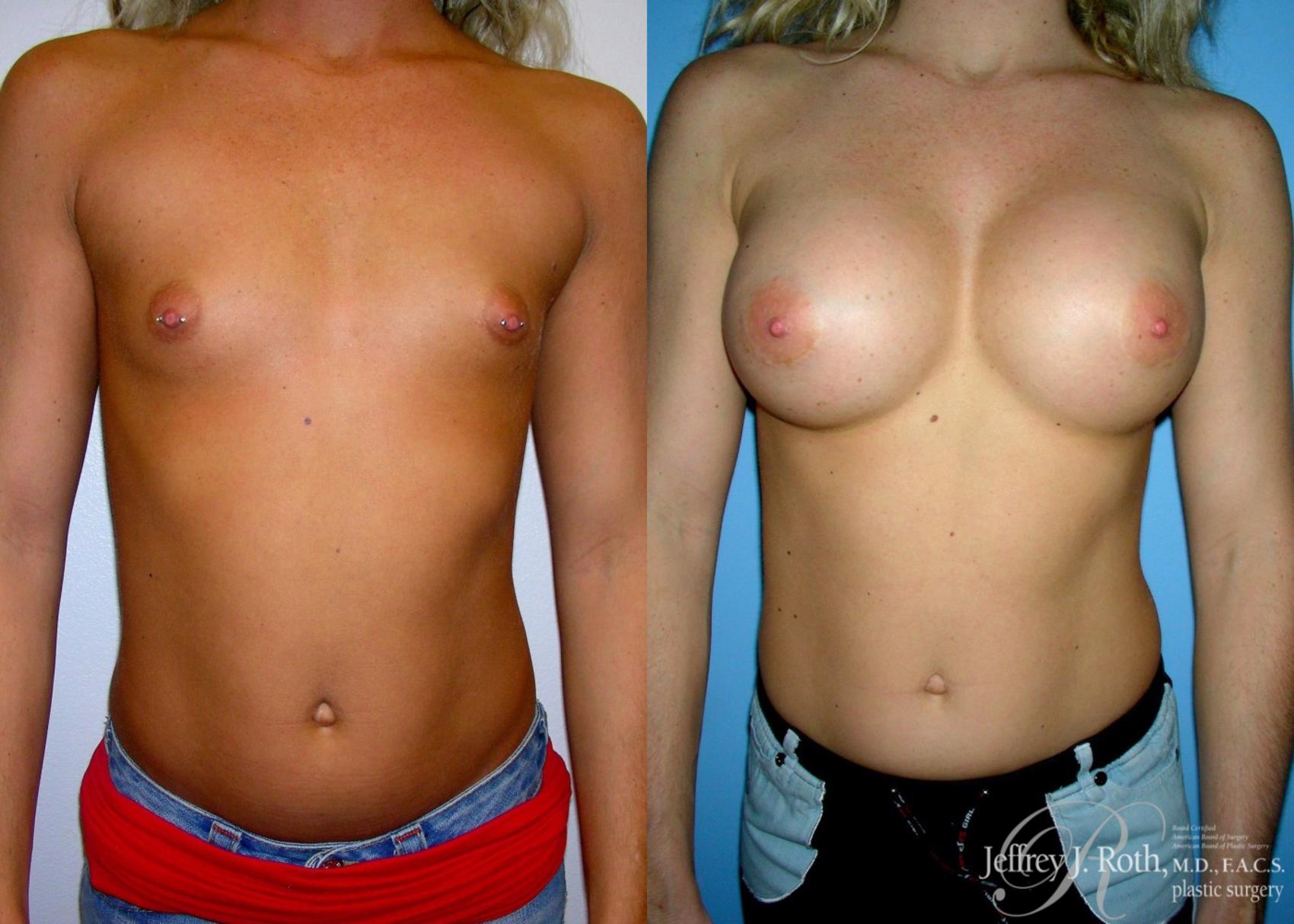 Before & After Large Breast Augmentation Case 94 View #1 View in Las Vegas, NV