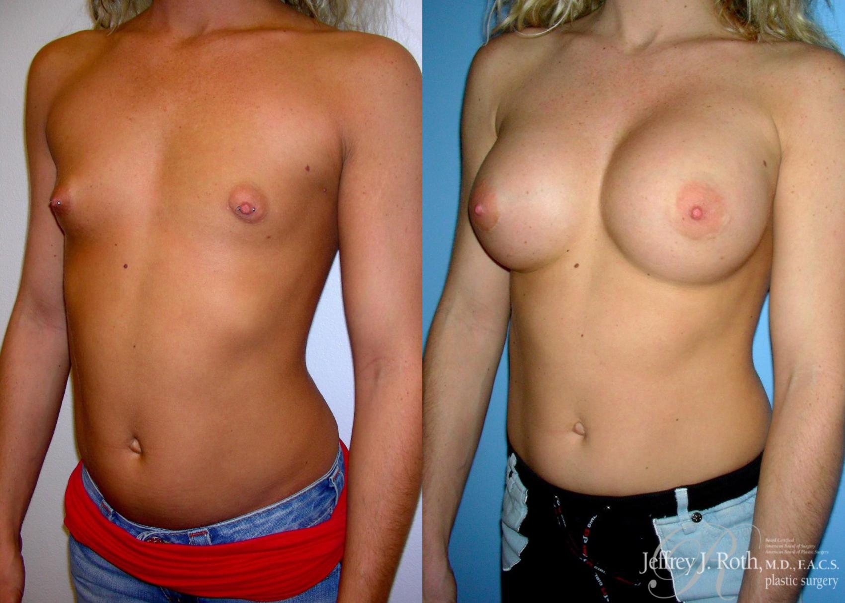 Before & After Large Breast Augmentation Case 94 View #2 View in Las Vegas, NV