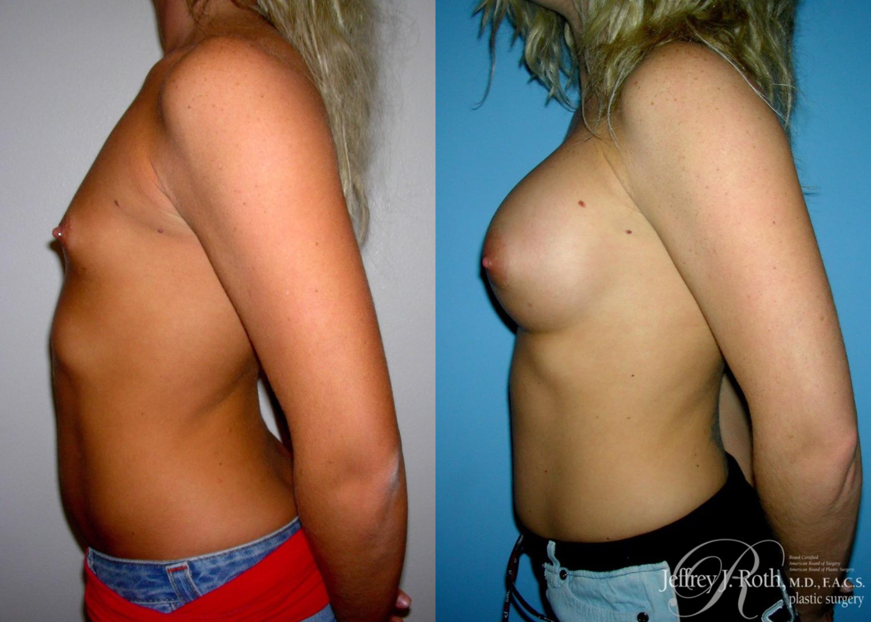 Before & After Large Breast Augmentation Case 94 View #3 View in Las Vegas, NV