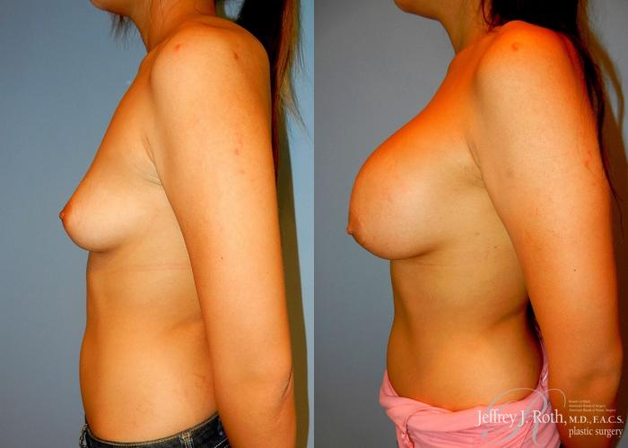 Before & After Large Breast Augmentation Case 95 View #3 View in Las Vegas and Henderson, NV